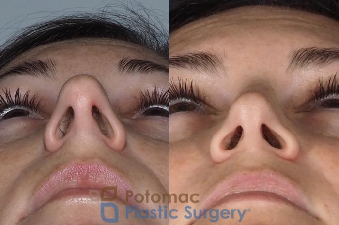 Before & After Rhinoplasty - Cosmetic Case 324 Bottom View in Washington DC & Arlington , DC