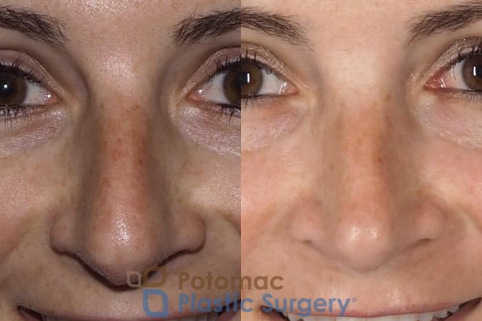 Before & After Rhinoplasty - Medical Case 324 Front - Smiling View in Washington DC & Arlington , DC