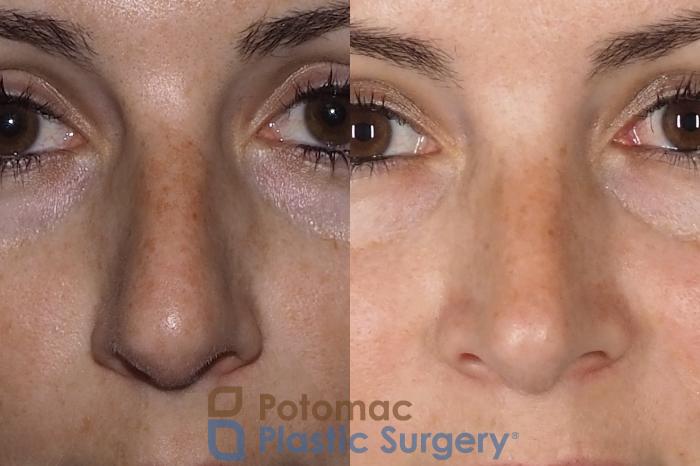Before & After Rhinoplasty - Cosmetic Case 324 Front View in Washington DC & Arlington , DC