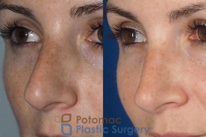 Before & After Rhinoplasty - Medical Case 324 Left Oblique View in Washington DC & Arlington , DC