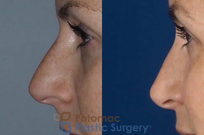 Before & After Rhinoplasty - Medical Case 324 Left Side View in Washington DC & Arlington , DC