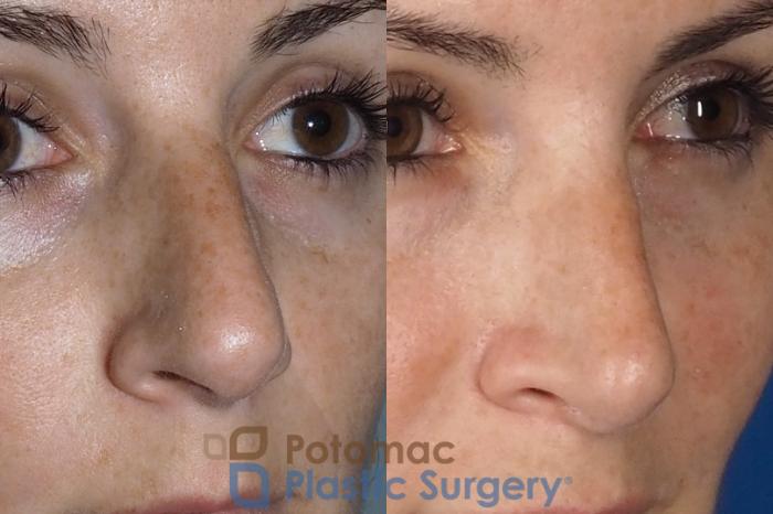 Before & After Rhinoplasty - Medical Case 324 Right Oblique View in Washington DC & Arlington , DC