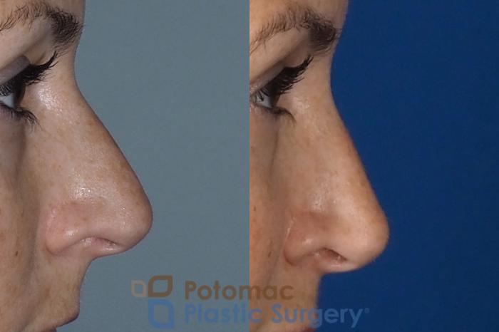 Before & After Rhinoplasty - Medical Case 324 Right Side View in Washington DC & Arlington , DC