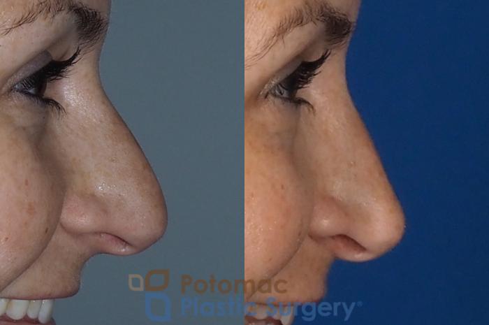 Before & After Rhinoplasty - Cosmetic Case 324 Right - Smiling View in Washington DC & Arlington , DC