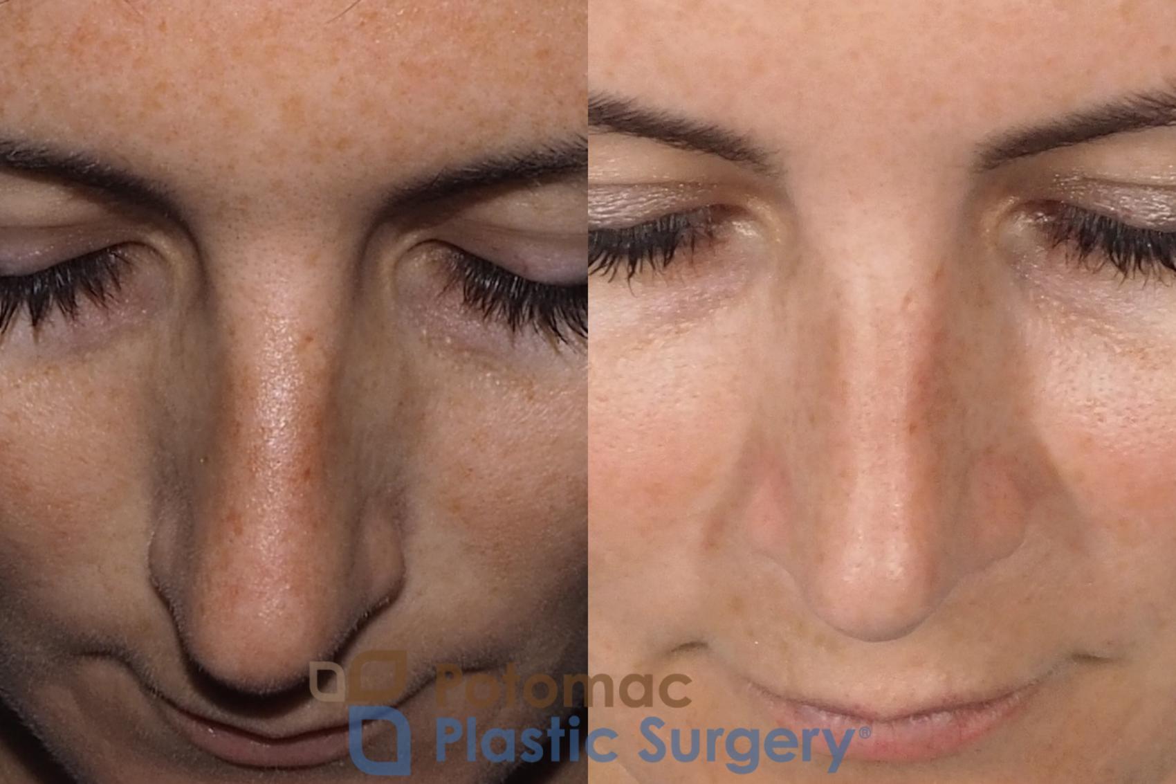 Before & After Rhinoplasty - Cosmetic Case 324 Top View in Washington DC & Arlington , DC