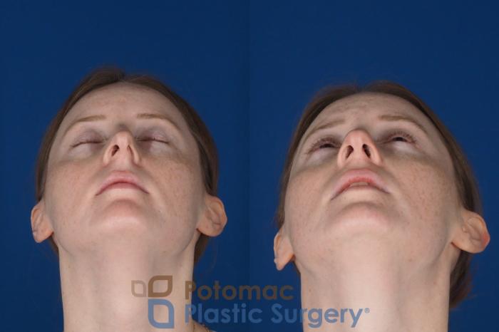 Before & After Rhinoplasty - Medical Case 327 Bottom - breathing View in Washington DC & Arlington , DC