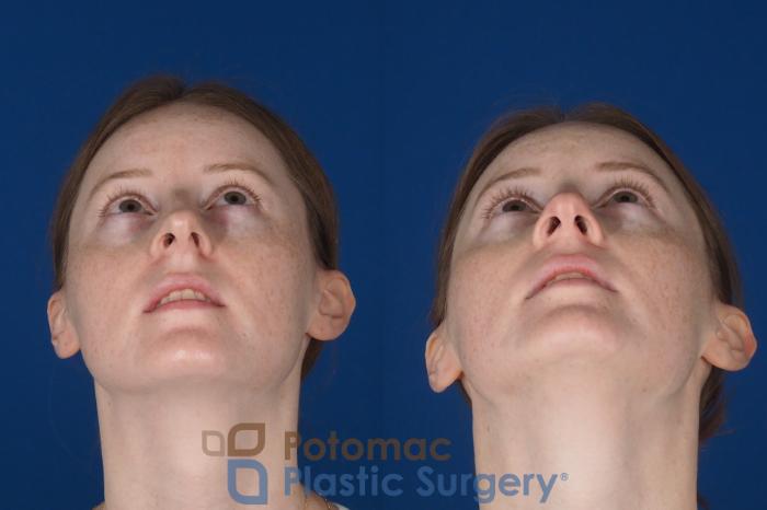 Before & After Rhinoplasty - Medical Case 327 Bottom View in Washington DC & Arlington , DC