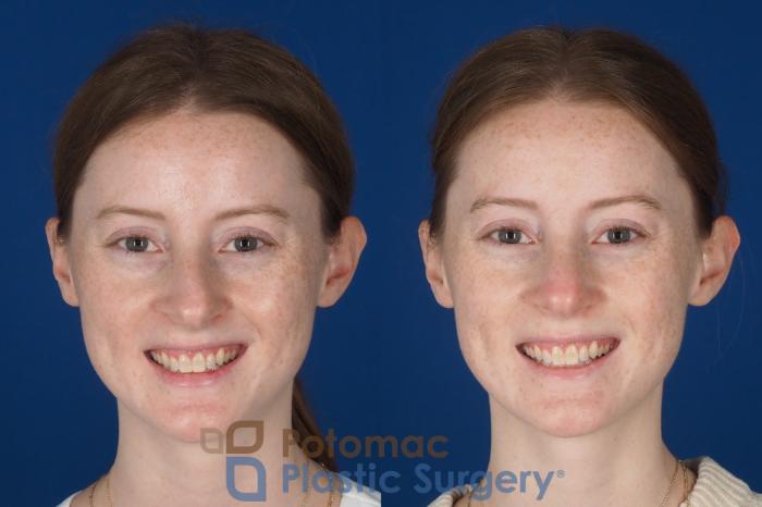 Before & After Rhinoplasty - Cosmetic Case 327 Front - Smiling View in Washington DC & Arlington , DC