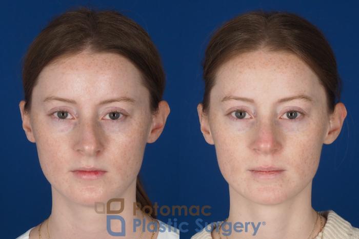 Before & After Rhinoplasty - Medical Case 327 Front View in Washington DC & Arlington , DC