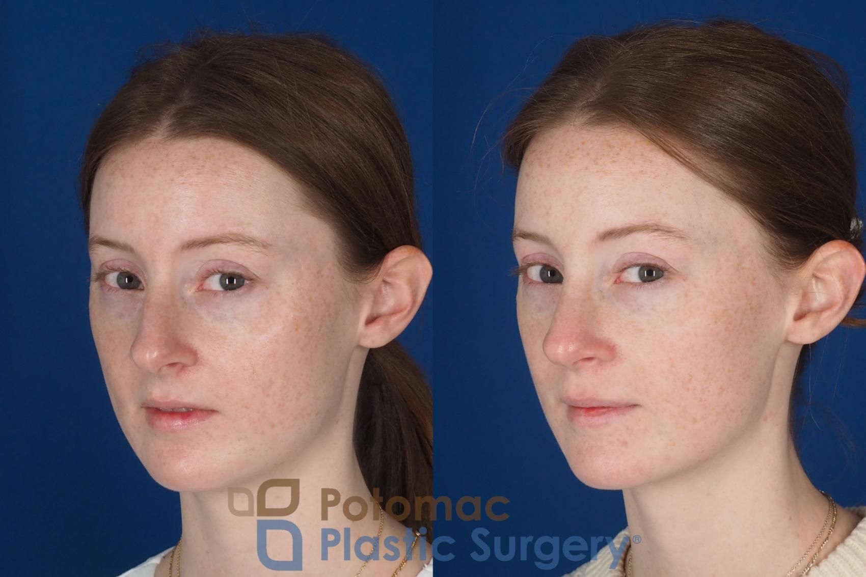 Before & After Rhinoplasty - Cosmetic Case 327 Left Oblique 2 View in Washington DC & Arlington , DC