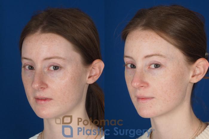 Before & After Rhinoplasty - Medical Case 327 Left Oblique 2 View in Washington DC & Arlington , DC