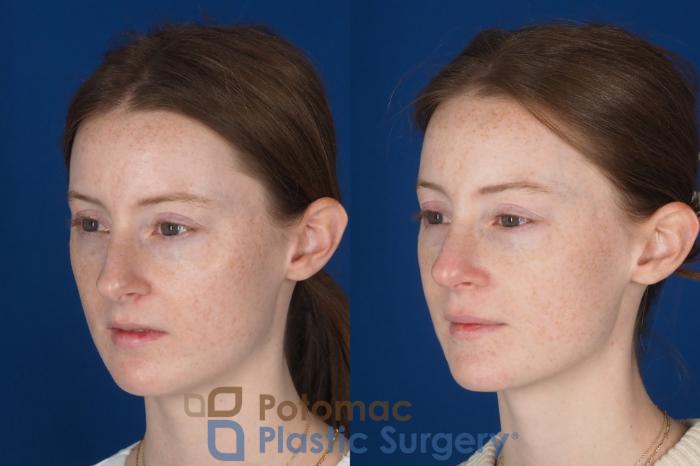 Before & After Rhinoplasty - Cosmetic Case 327 Left Oblique View in Washington DC & Arlington , DC