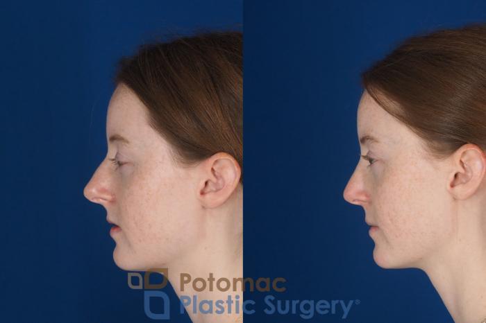Before & After Rhinoplasty - Cosmetic Case 327 Left Side View in Washington DC & Arlington , DC