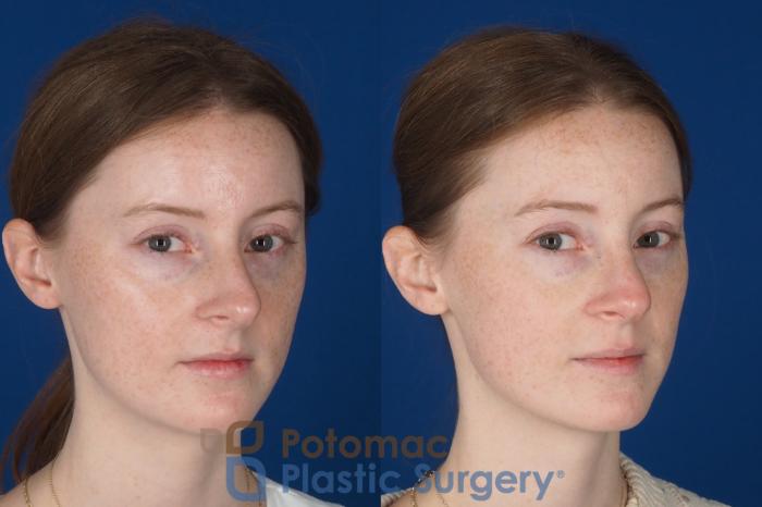 Before & After Rhinoplasty - Medical Case 327 Right Oblique 2 View in Washington DC & Arlington , DC