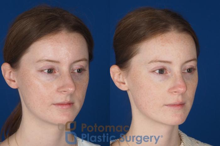 Before & After Rhinoplasty - Medical Case 327 Right Oblique View in Washington DC & Arlington , DC