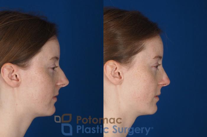 Before & After Rhinoplasty - Medical Case 327 Right Side View in Washington DC & Arlington , DC