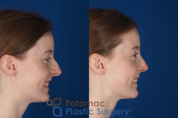Before & After Rhinoplasty - Cosmetic Case 327 Right - Smiling View in Washington DC & Arlington , DC