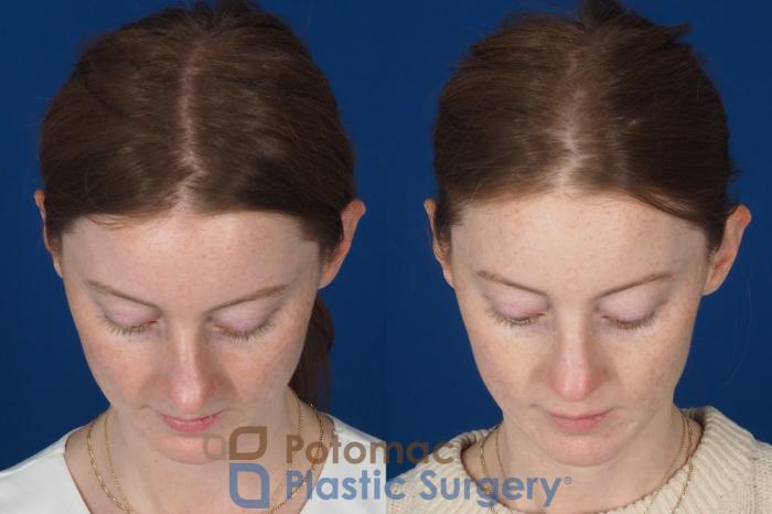 Before & After Rhinoplasty - Medical Case 327 Top View in Washington DC & Arlington , DC