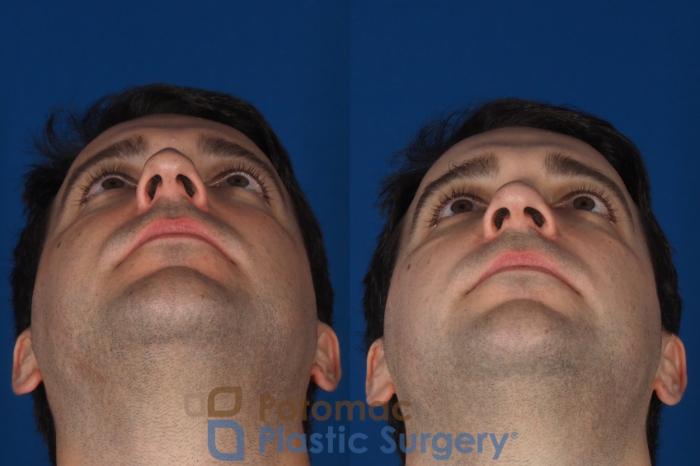 Before & After Rhinoplasty - Medical Case 329 Bottom View in Washington DC & Arlington , DC