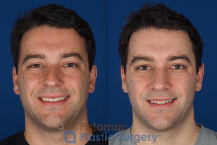 Before & After Rhinoplasty - Medical Case 329 Front - Smiling View in Washington DC & Arlington , DC
