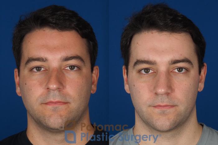 Before & After Rhinoplasty - Cosmetic Case 329 Front View in Washington DC & Arlington , DC