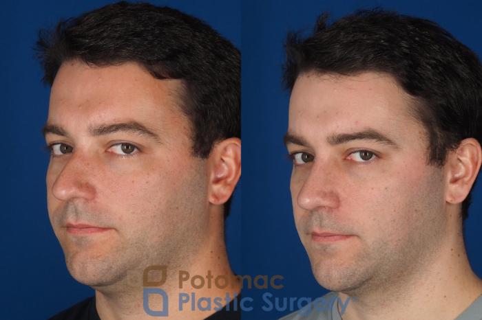 Before & After Rhinoplasty - Cosmetic Case 329 Left Oblique 2 View in Washington DC & Arlington , DC