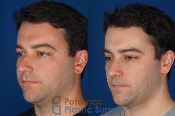 Before & After Rhinoplasty - Medical Case 329 Left Oblique View in Washington DC & Arlington , DC