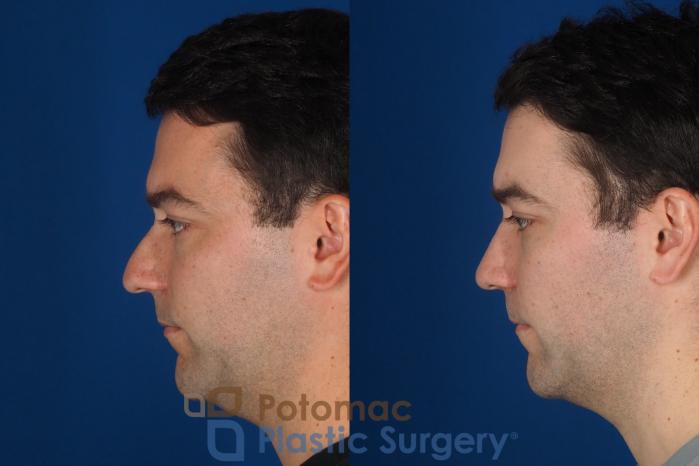 Before & After Rhinoplasty - Cosmetic Case 329 Left Side View in Washington DC & Arlington , DC