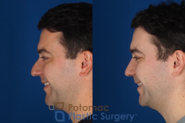 Before & After Rhinoplasty - Cosmetic Case 329 Left - Smiling View in Washington DC & Arlington , DC