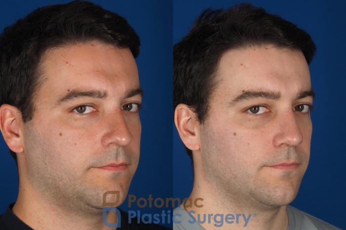 Before & After Rhinoplasty - Medical Case 329 Right Oblique 2 View in Washington DC & Arlington , DC