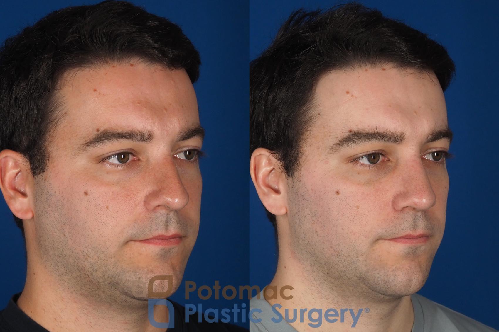 Before & After Rhinoplasty - Medical Case 329 Right Oblique View in Washington DC & Arlington , DC