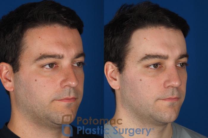 Before & After Rhinoplasty - Cosmetic Case 329 Right Oblique View in Washington DC & Arlington , DC