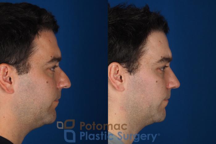 Before & After Rhinoplasty - Medical Case 329 Right Side View in Washington DC & Arlington , DC