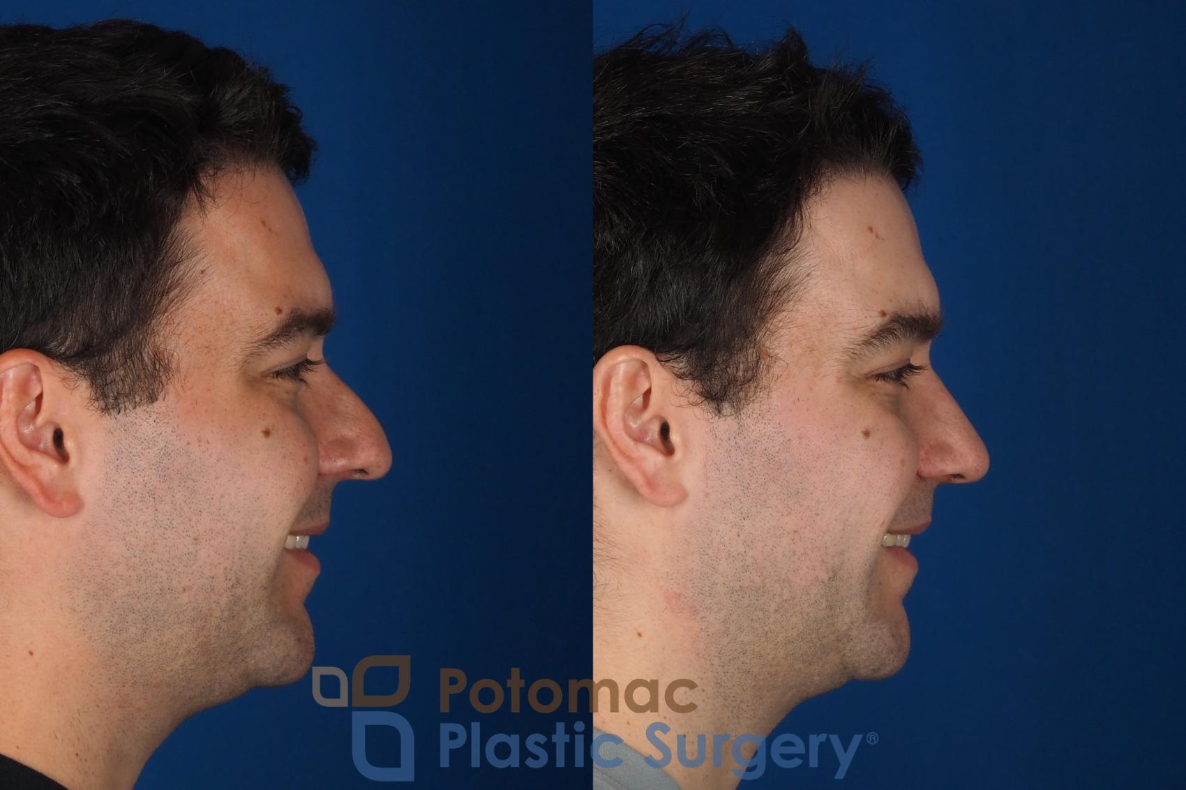 Before & After Rhinoplasty - Medical Case 329 Right - Smiling View in Washington DC & Arlington , DC