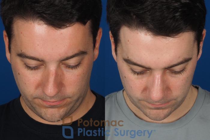 Before & After Rhinoplasty - Medical Case 329 Top View in Washington DC & Arlington , DC