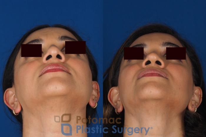 Before & After Rhinoplasty - Medical Case 334 Bottom View in Washington DC & Arlington , DC