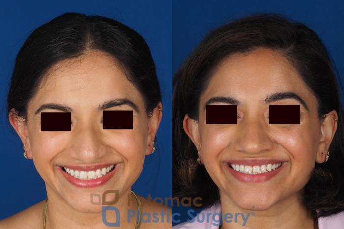 Before & After Rhinoplasty - Cosmetic Case 334 Front - Smiling View in Washington DC & Arlington , DC