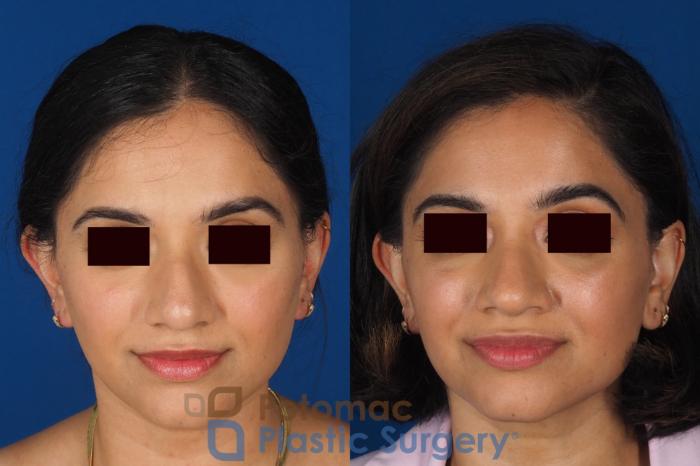 Before & After Rhinoplasty - Cosmetic Case 334 Front View in Washington DC & Arlington , DC