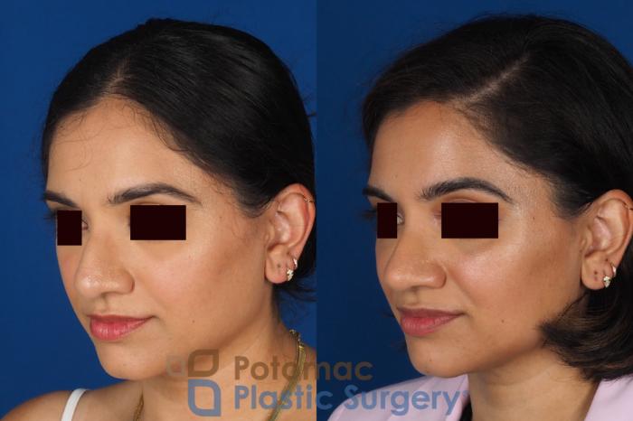 Before & After Rhinoplasty - Medical Case 334 Left Oblique View in Washington DC & Arlington , DC