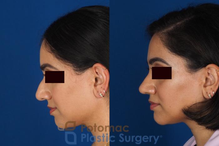 Before & After Rhinoplasty - Cosmetic Case 334 Left Side View in Washington DC & Arlington , DC