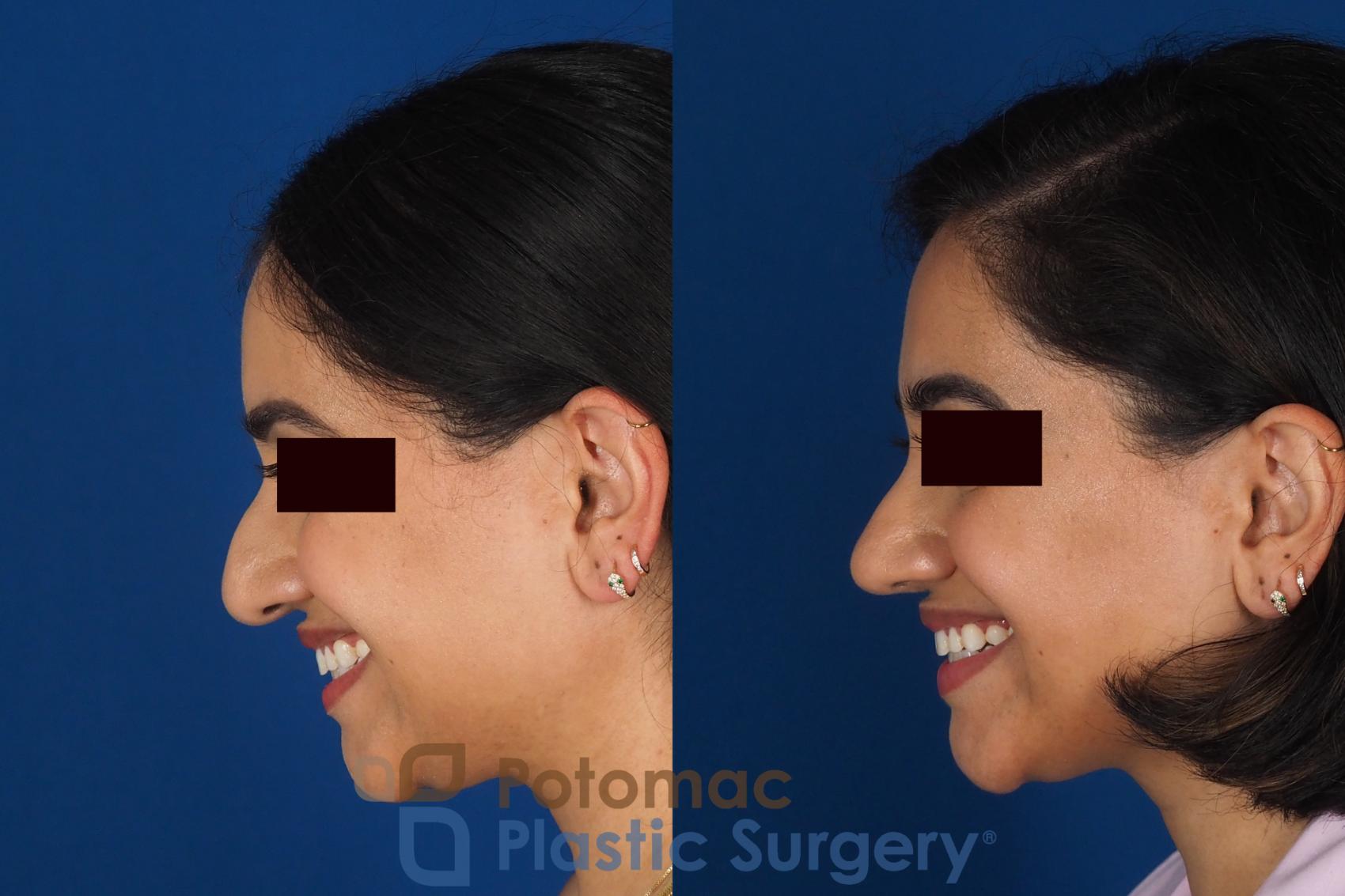 Before & After Rhinoplasty - Cosmetic Case 334 Left - Smiling View in Washington DC & Arlington , DC