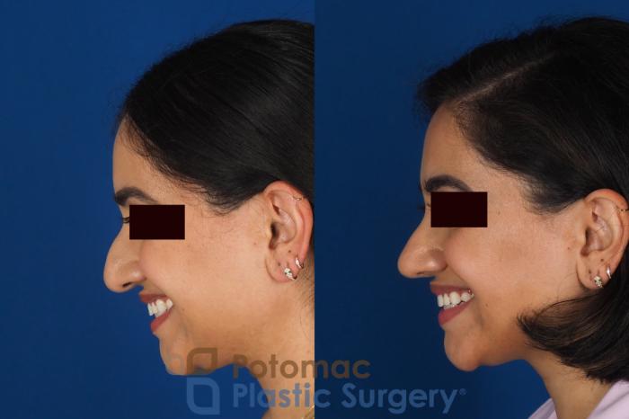 Before & After Rhinoplasty - Cosmetic Case 334 Left - Smiling View in Washington DC & Arlington , DC