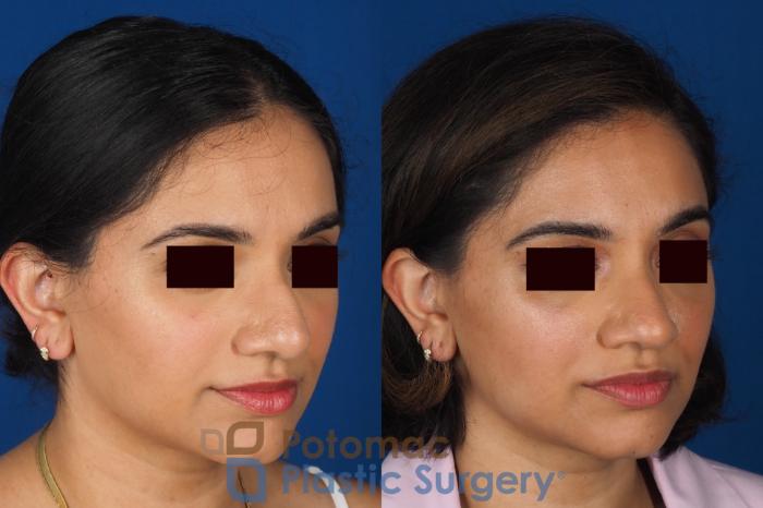 Before & After Rhinoplasty - Cosmetic Case 334 Right Oblique View in Washington DC & Arlington , DC