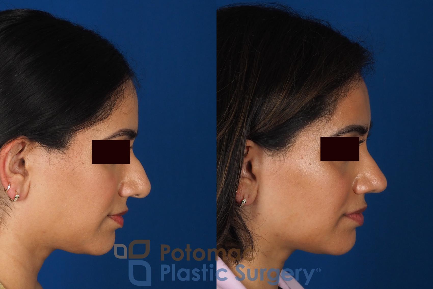 Before & After Rhinoplasty - Medical Case 334 Right Side View in Washington DC & Arlington , DC