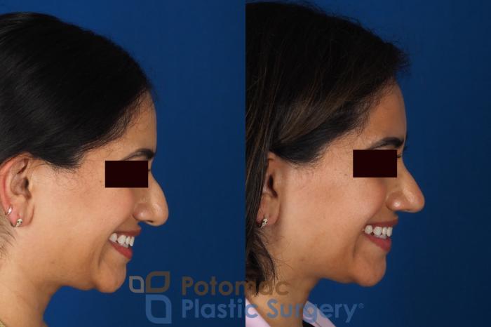 Before & After Rhinoplasty - Cosmetic Case 334 Right - Smiling View in Washington DC & Arlington , DC