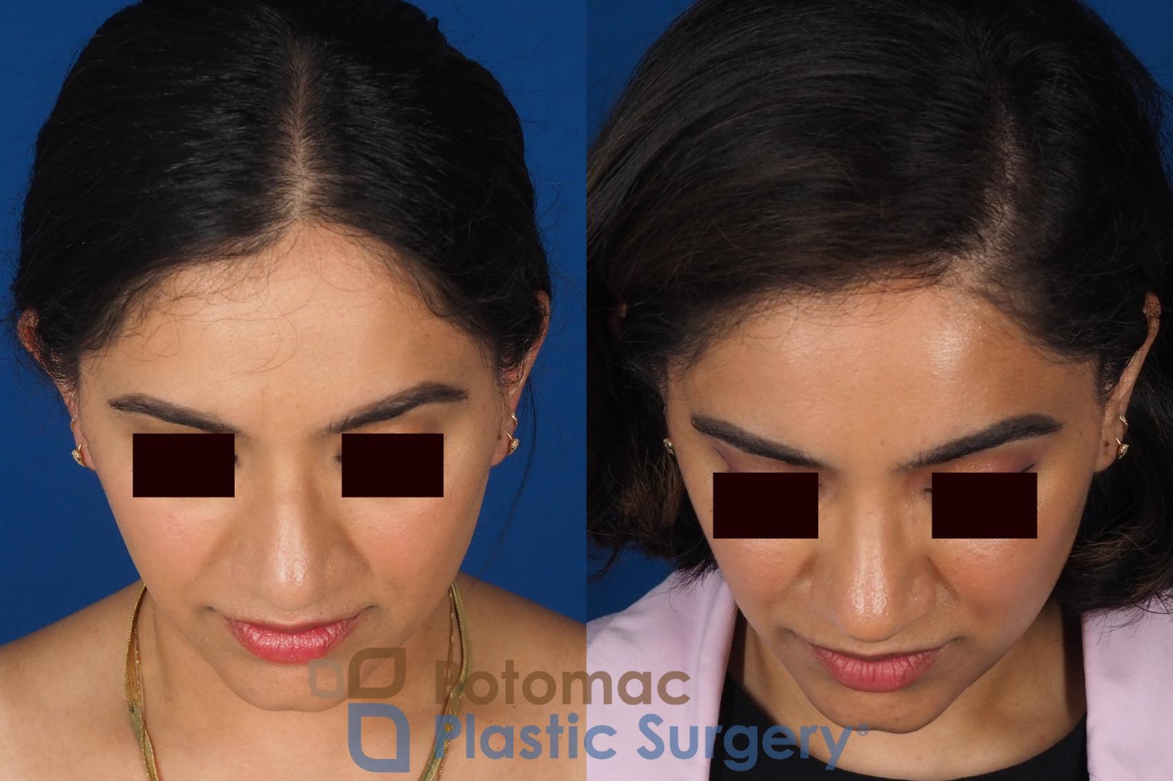 Before & After Rhinoplasty - Cosmetic Case 334 Top View in Washington DC & Arlington , DC