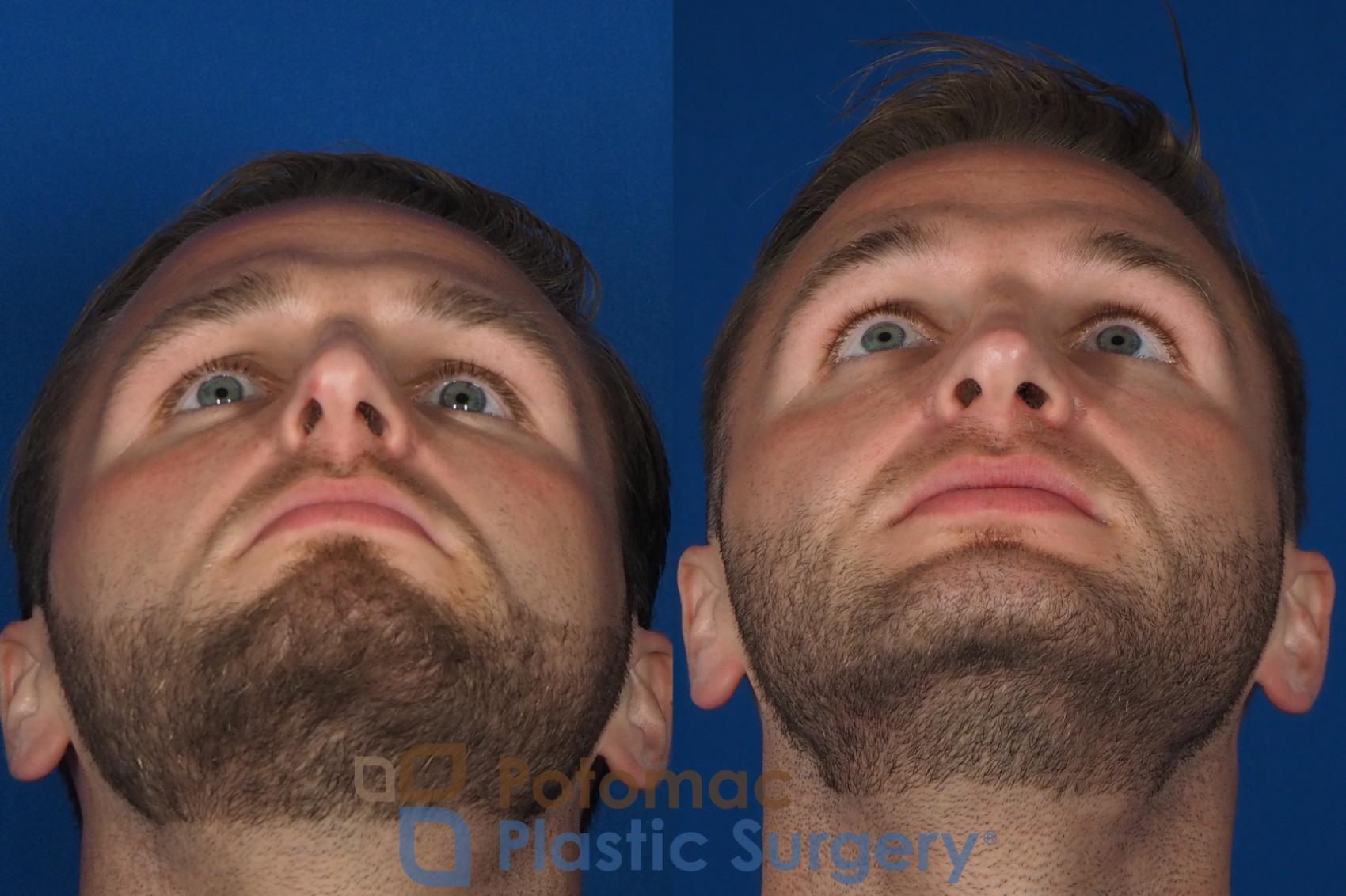 Before & After Rhinoplasty - Medical Case 335 Bottom View in Washington DC & Arlington , DC
