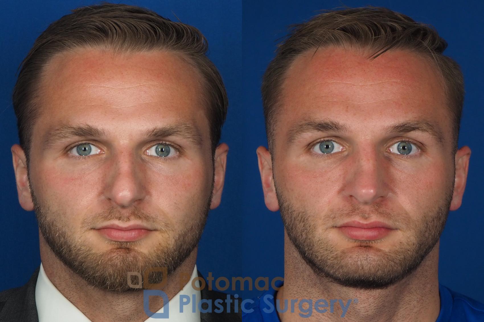 Before & After Rhinoplasty - Medical Case 335 Front View in Washington DC & Arlington , DC