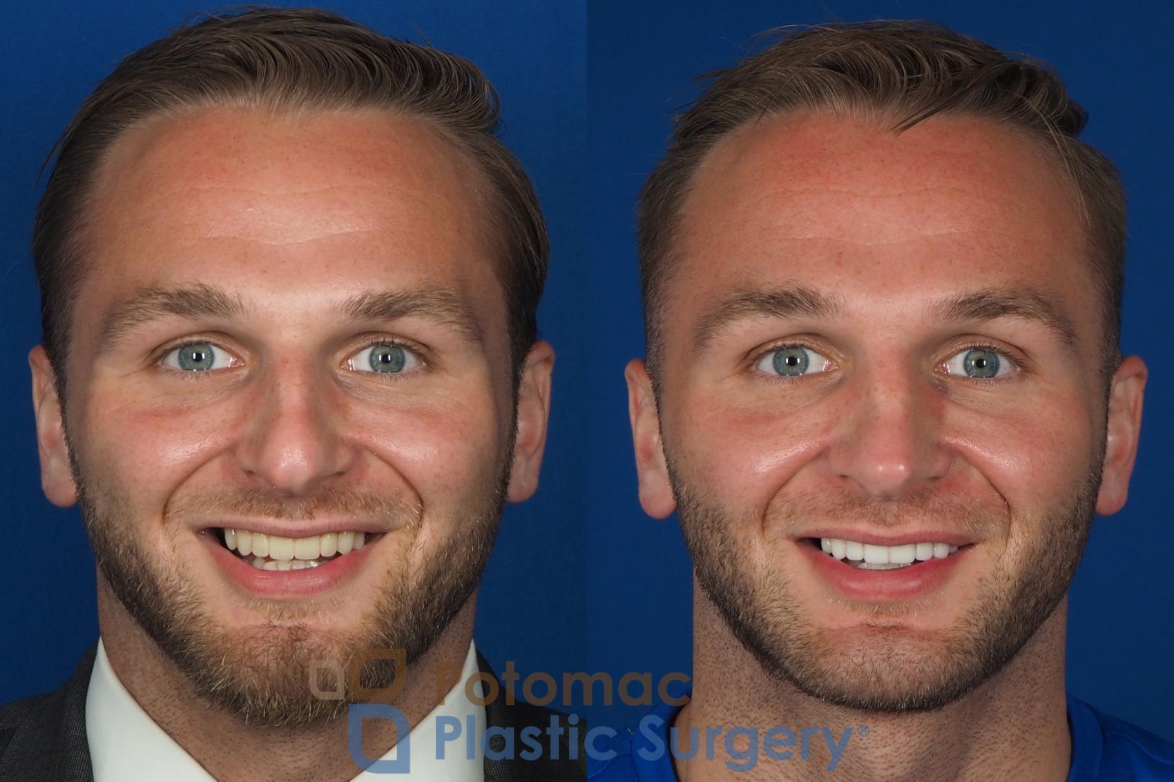 Before & After Rhinoplasty - Medical Case 335 Front - Smiling View in Washington DC & Arlington , DC
