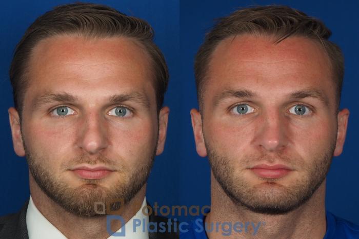 Before & After Rhinoplasty - Cosmetic Case 335 Front View in Washington DC & Arlington , DC